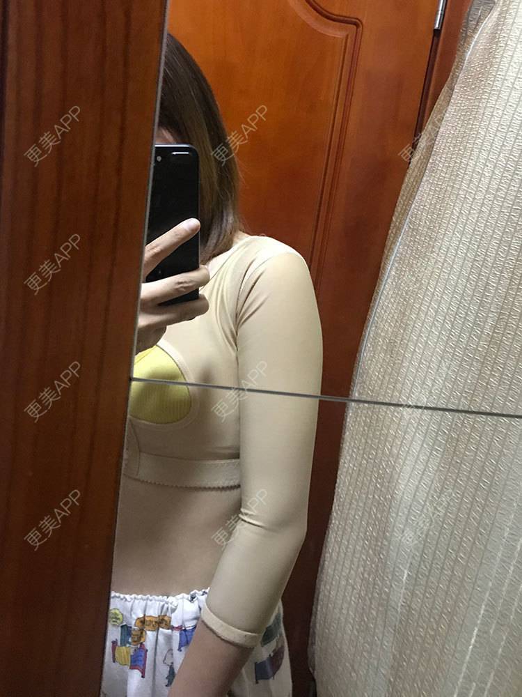 更美 - 更美用户he4cSABruG的手臂吸脂经验 | 手臂吸脂 | 广州