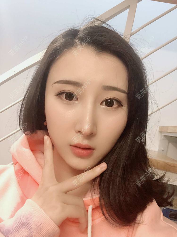 更美 - 徐利利的鼻部修复经验 | 鼻部修复 | 广州 | 耳软骨隆鼻 | 鼻部多项