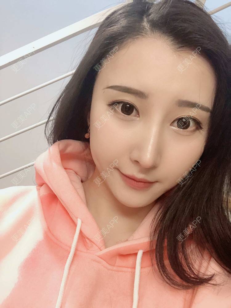更美 - 徐利利的鼻部修复经验 | 鼻部修复 | 广州 | 耳软骨隆鼻 | 鼻部多项