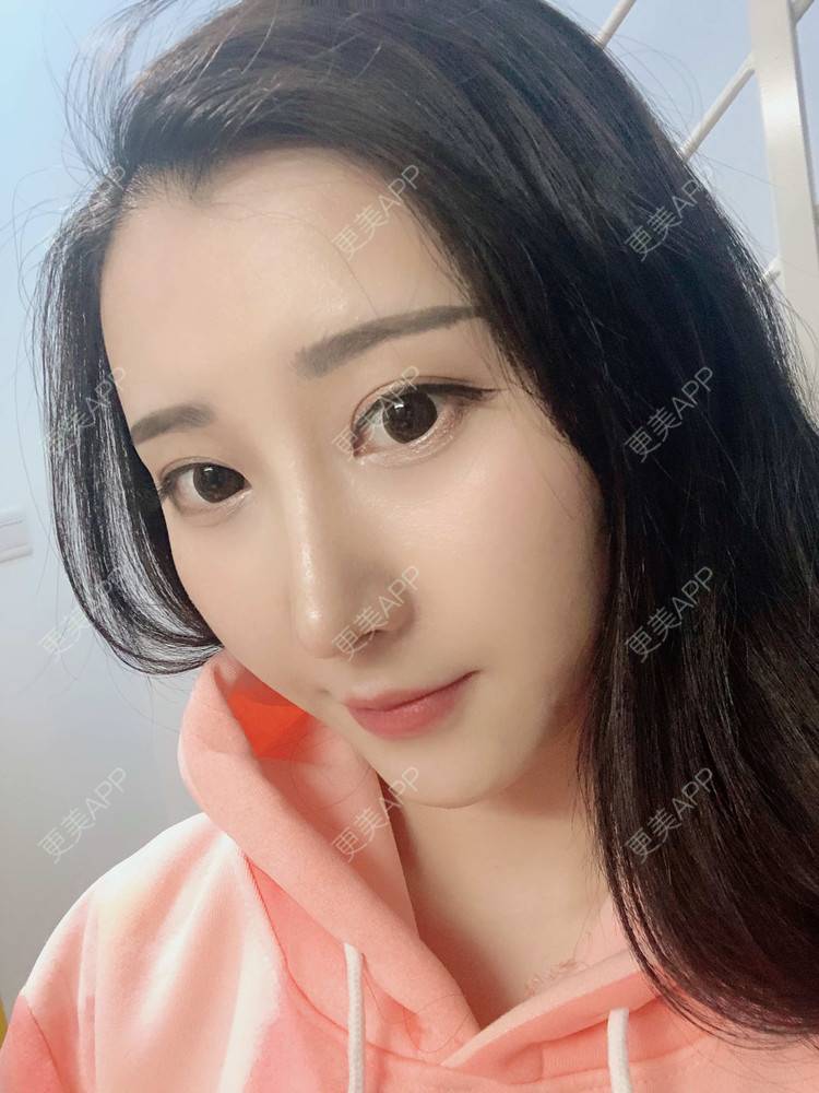 更美 - 徐利利的鼻部修复经验 | 鼻部修复 | 广州 | 耳软骨隆鼻 | 鼻部多项