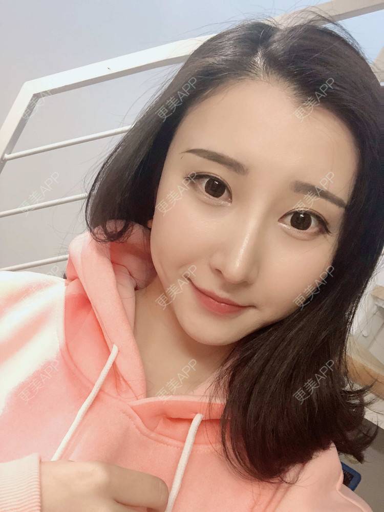 更美 - 徐利利的鼻部修复经验 | 鼻部修复 | 广州 | 耳软骨隆鼻 | 鼻部多项