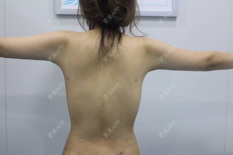 更美 - 心心念心心念的吸脂瘦大腿经验 | 吸脂瘦大腿 | 腰部吸脂 | 超声溶脂瘦腰部 | 超声溶脂瘦大腿 | 手臂吸脂 | 哈尔滨 | 腹部吸脂 | 吸脂