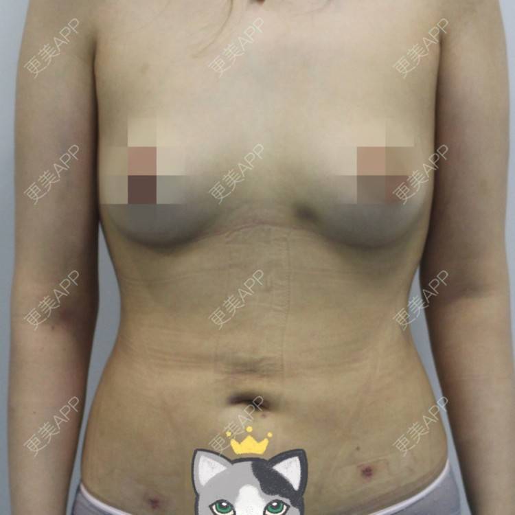 更美 - 心心念心心念的吸脂瘦大腿经验 | 吸脂瘦大腿 | 腰部吸脂 | 超声溶脂瘦腰部 | 超声溶脂瘦大腿 | 手臂吸脂 | 哈尔滨 | 腹部吸脂 | 吸脂