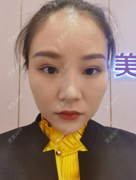 更美 - 更美用户wOARiRO1Ls的真皮丰卧蚕经验 | 北京 | 视频日记 | 真皮丰卧蚕