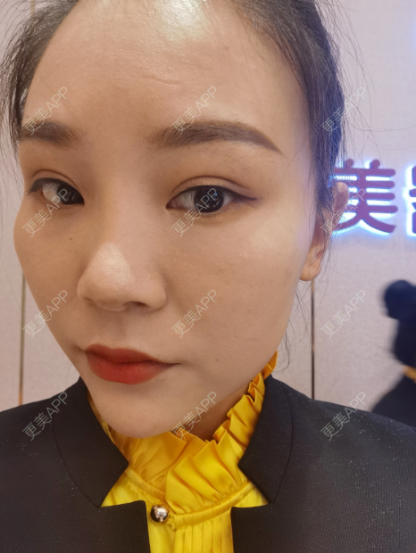 更美 - 更美用户wOARiRO1Ls的真皮丰卧蚕经验 | 北京 | 视频日记 | 真皮丰卧蚕
