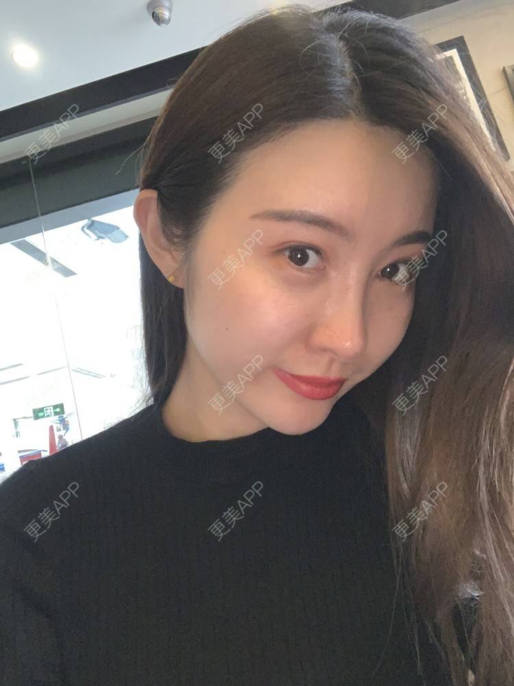 更美 - Angel姐的真皮隆鼻经验 | 北京 | 视频日记 | 真皮隆鼻