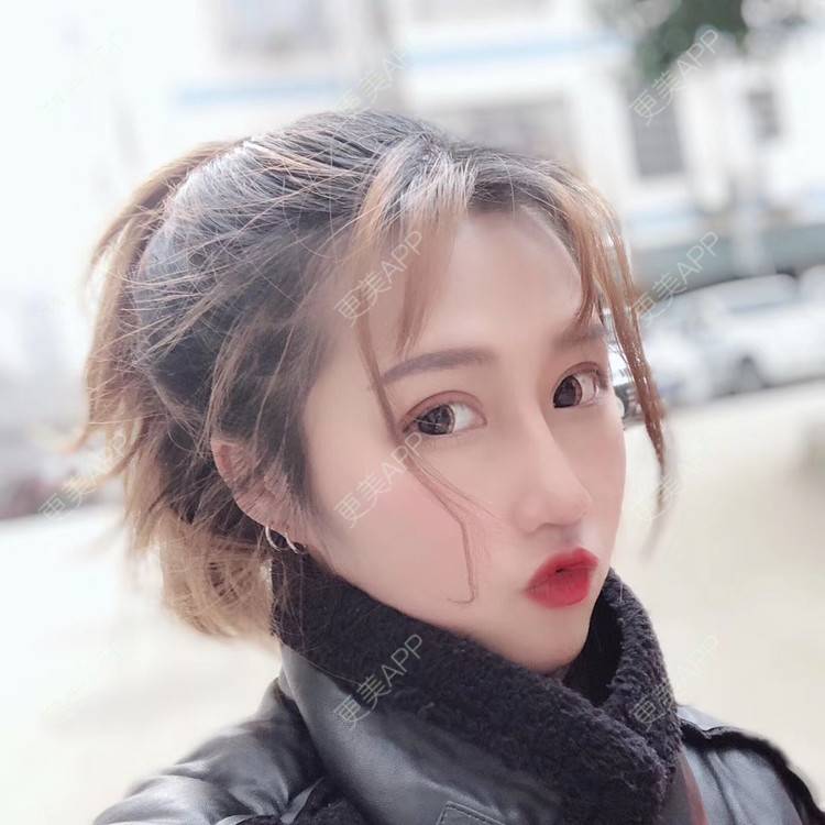 更美 - 萤萤如画的颧骨内推经验 | 广州 | 颧骨内推 | 视频日记