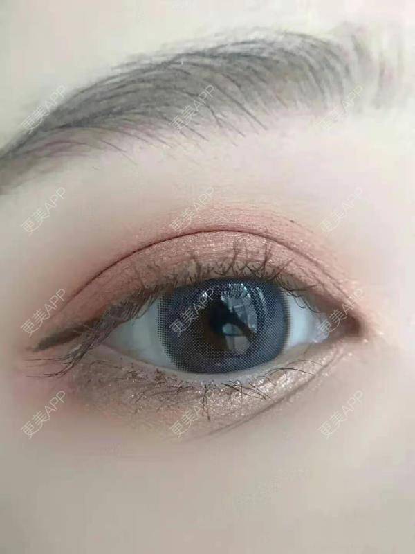 双眼皮,双眼皮效果图_花花鸭花双眼皮效果图_术后163天__更美