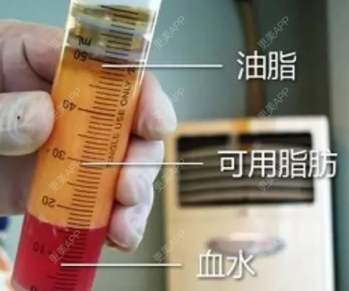 更美 - 更美用户RvtaZv7v51的自体脂肪面部年轻化经验 | 自体脂肪面部年轻化