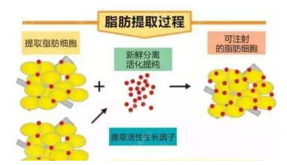 更美 - 更美用户RvtaZv7v51的自体脂肪面部年轻化经验 | 自体脂肪面部年轻化