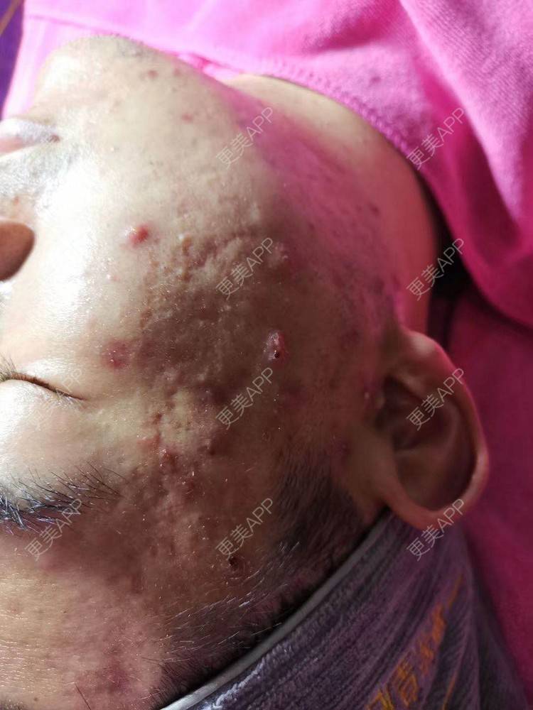 更美 - 小可爱 嘤嘤～的光子嫩肤经验 | 水杨酸焕肤 | 光子嫩肤 | 沈阳