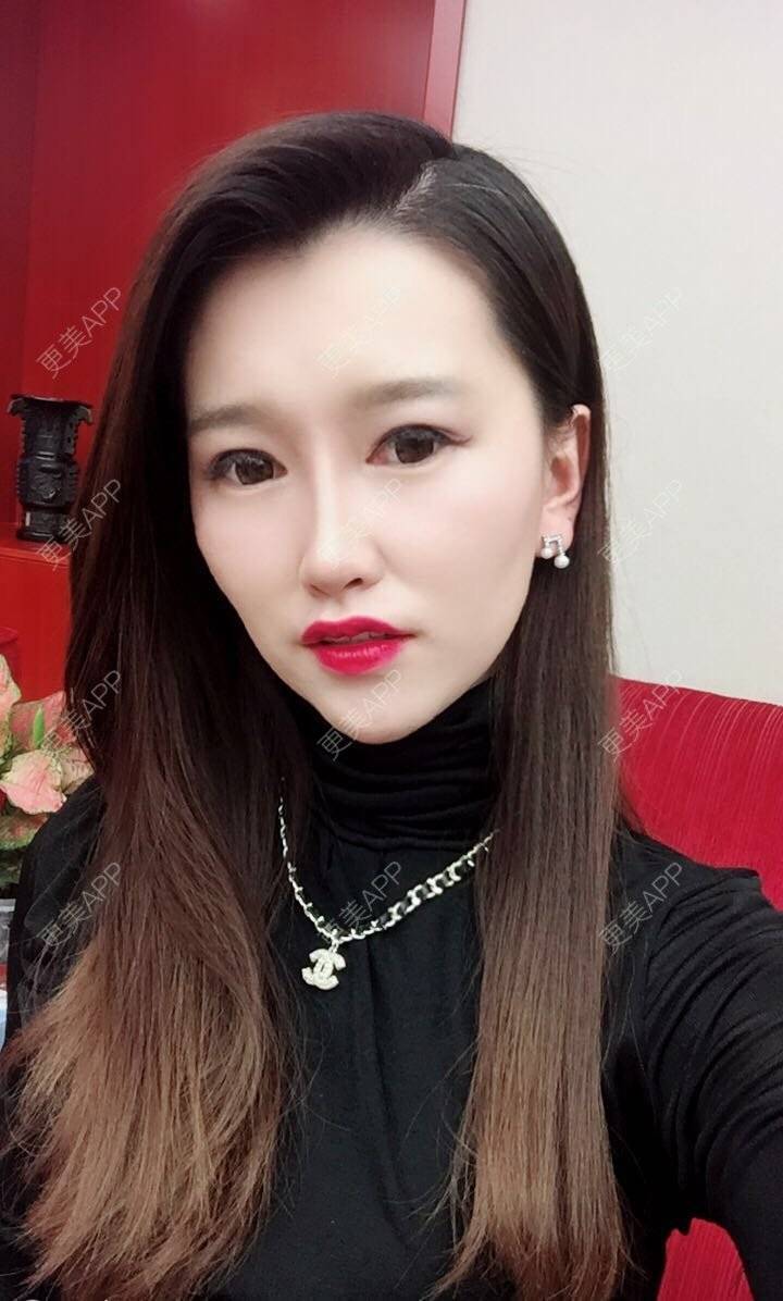 更美 - 听董了吗的真皮隆鼻经验 | 北京 | 真皮隆鼻