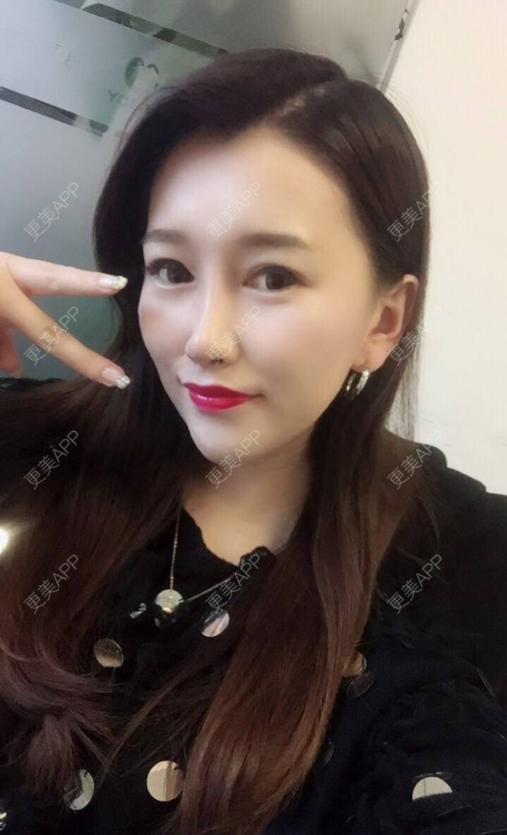 更美 - 听董了吗的真皮隆鼻经验 | 北京 | 真皮隆鼻