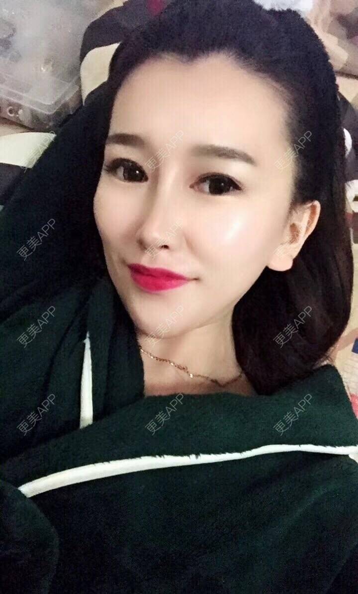 更美 - 听董了吗的真皮隆鼻经验 | 北京 | 真皮隆鼻