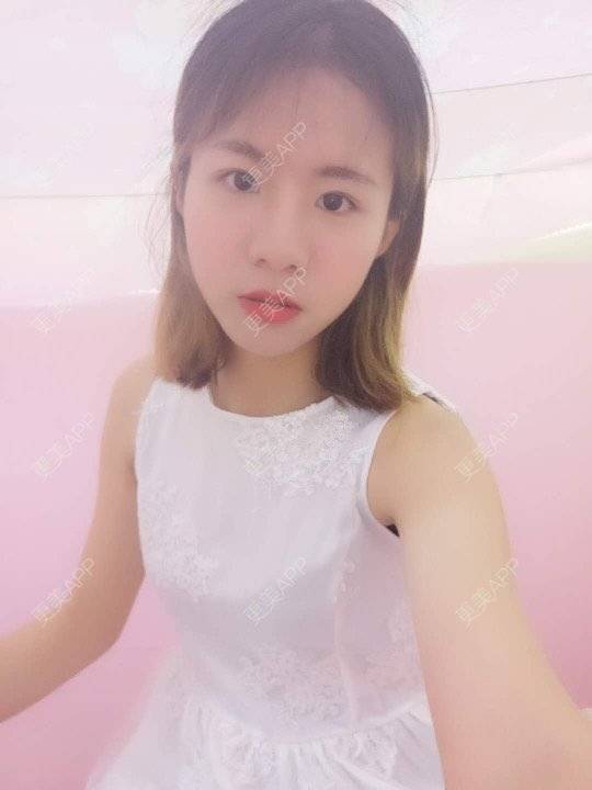 更美 - 更美用户y7L5mSdiiG的埋线提升经验 | 埋线提升 | 广州