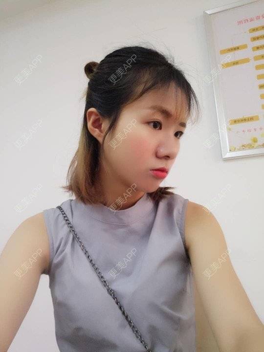 更美 - 更美用户y7L5mSdiiG的埋线提升经验 | 埋线提升 | 广州