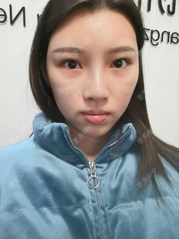 更美 - 更美用户82701801的隐形牙齿矫正经验 | 杭州