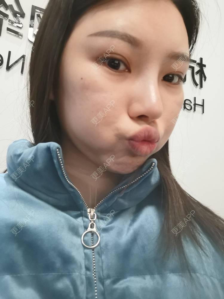 更美 - 更美用户82701801的隐形牙齿矫正经验 | 杭州