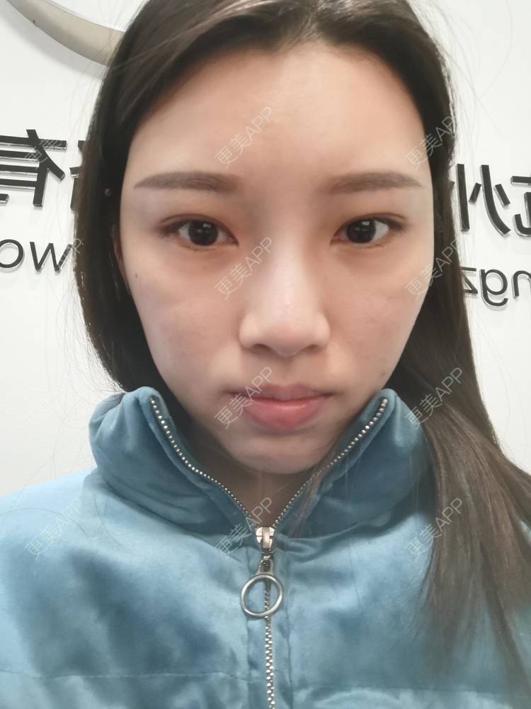 更美 - 更美用户82701801的隐形牙齿矫正经验 | 杭州