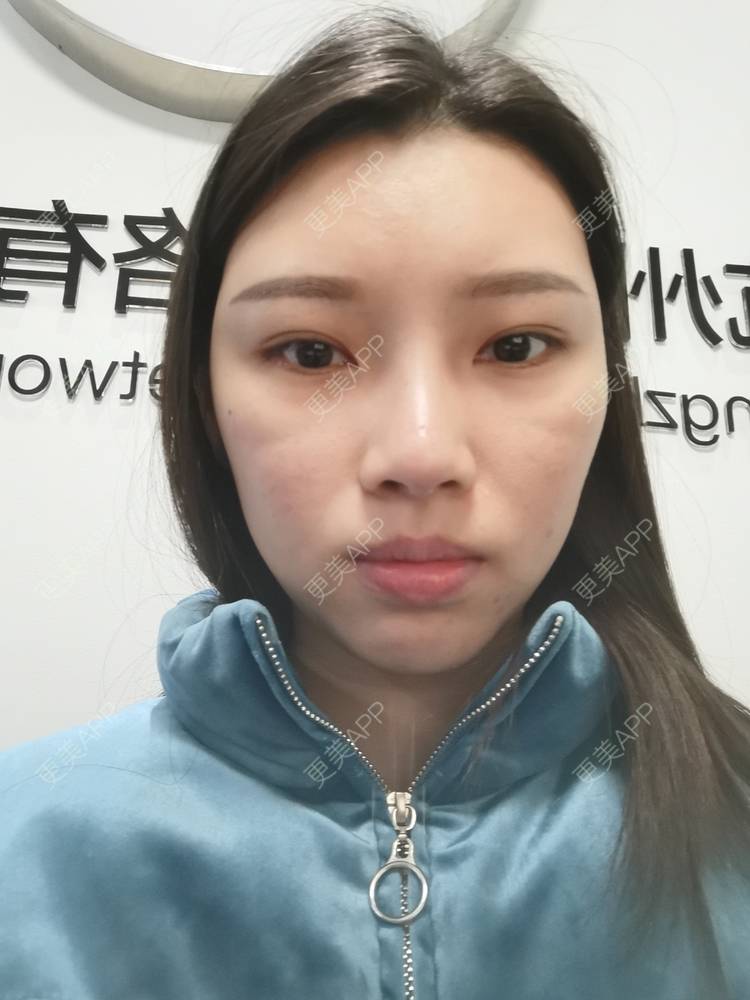 更美 - 更美用户82701801的隐形牙齿矫正经验 | 杭州