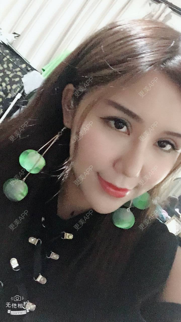 更美 - 泡面MM的鼻部膨体假体取出经验 | 鼻部膨体假体取出 | 视频日记 | 重庆