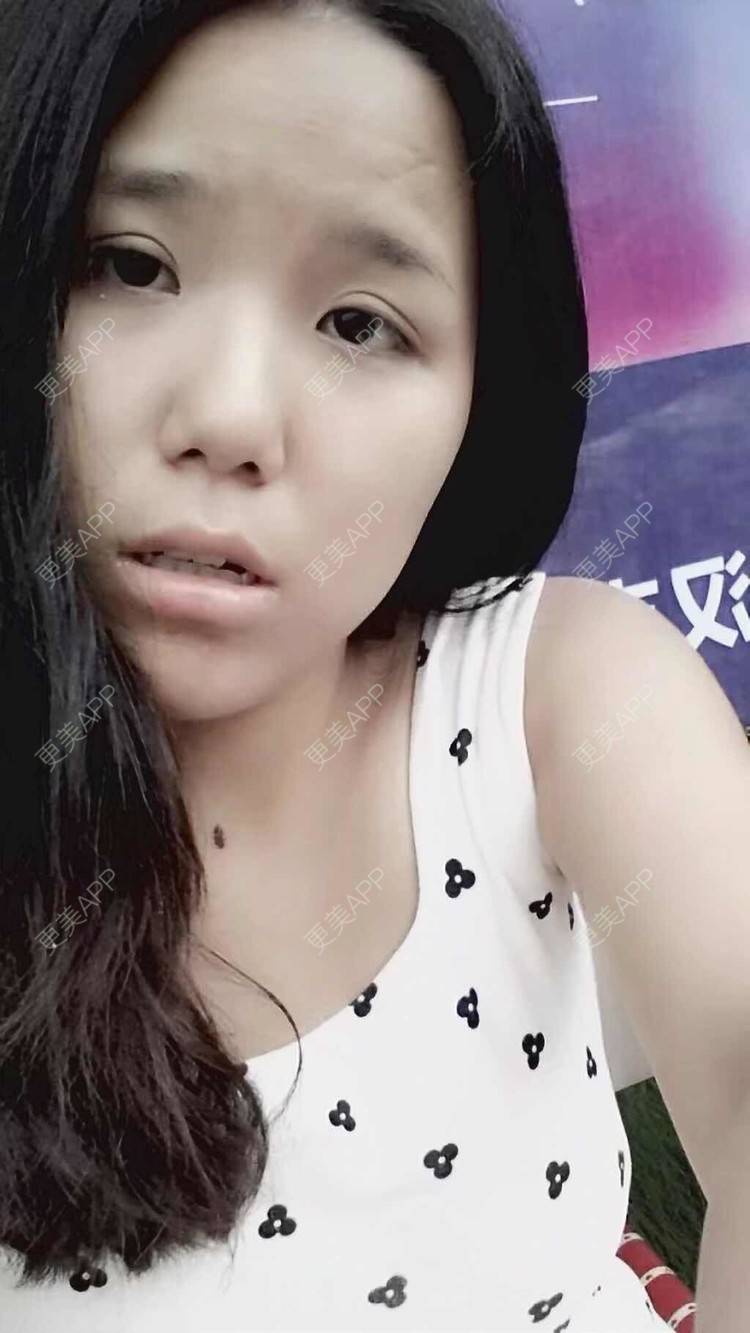 更美 - 泡面MM的鼻部膨体假体取出经验 | 鼻部膨体假体取出 | 视频日记 | 重庆