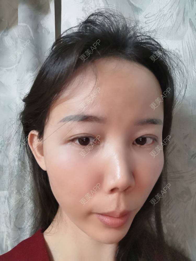 更美 - 更美用户tSMW9UjrQn的水光项目经验 | 广州 | 水光项目