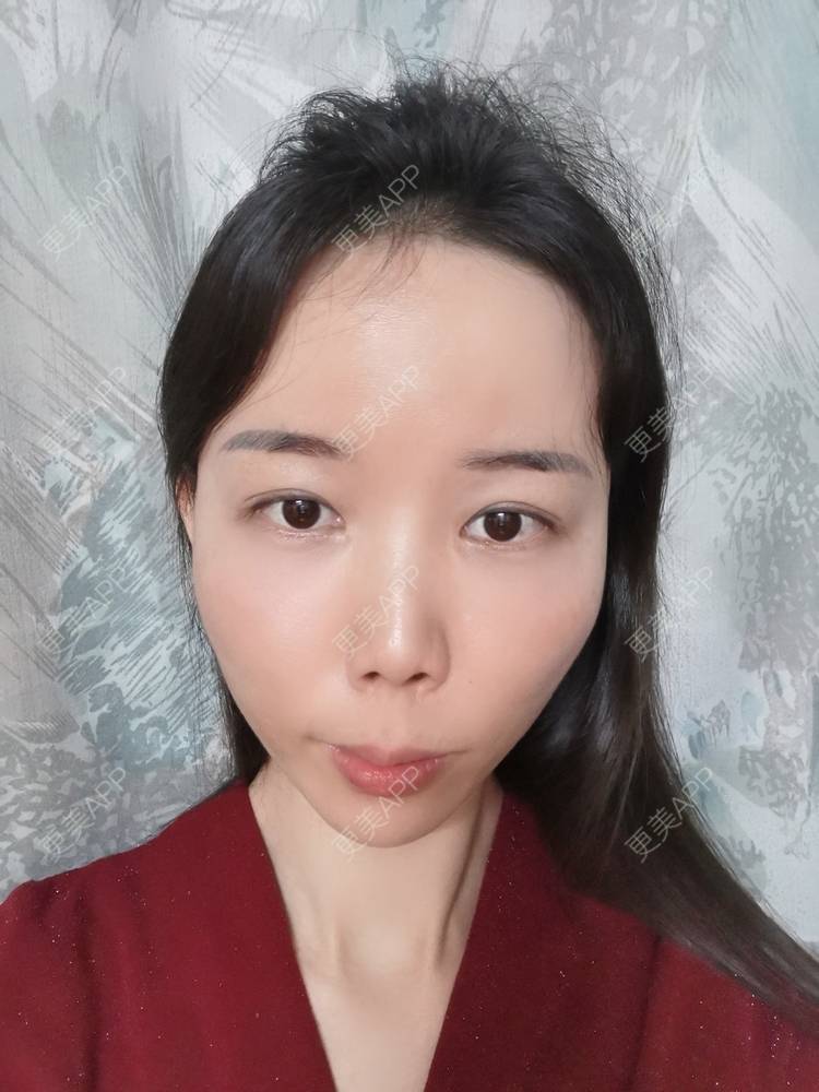 更美 - 更美用户tSMW9UjrQn的水光项目经验 | 广州 | 水光项目