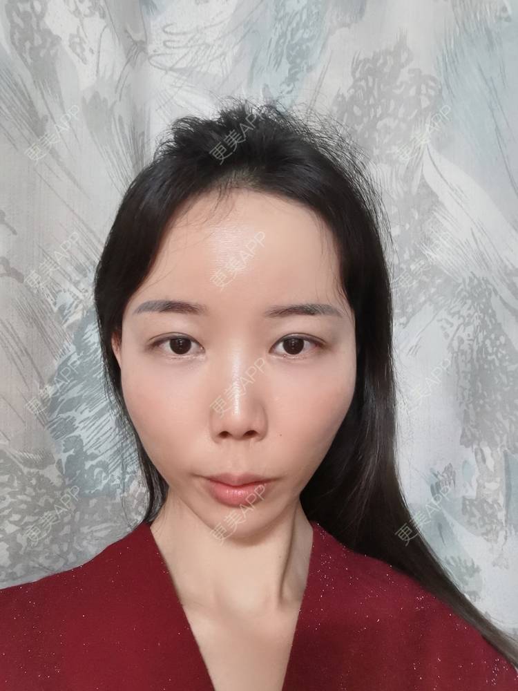 更美 - 更美用户tSMW9UjrQn的水光项目经验 | 广州 | 水光项目