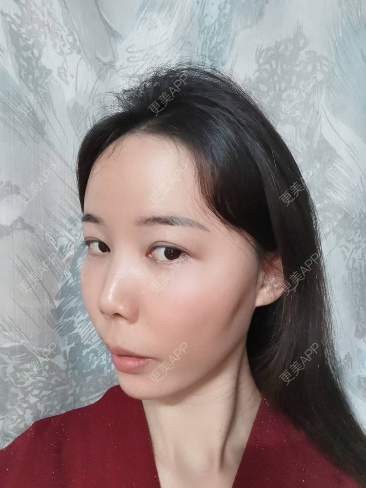 更美 - 更美用户tSMW9UjrQn的水光项目经验 | 广州 | 水光项目
