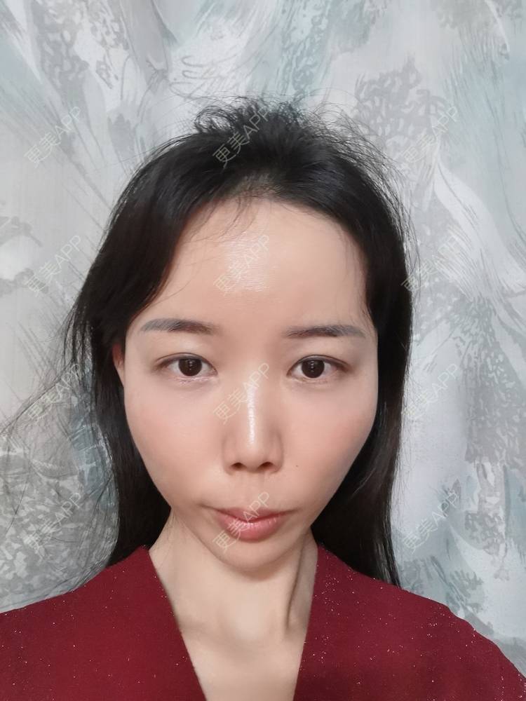 更美 - 更美用户tSMW9UjrQn的水光项目经验 | 广州 | 水光项目