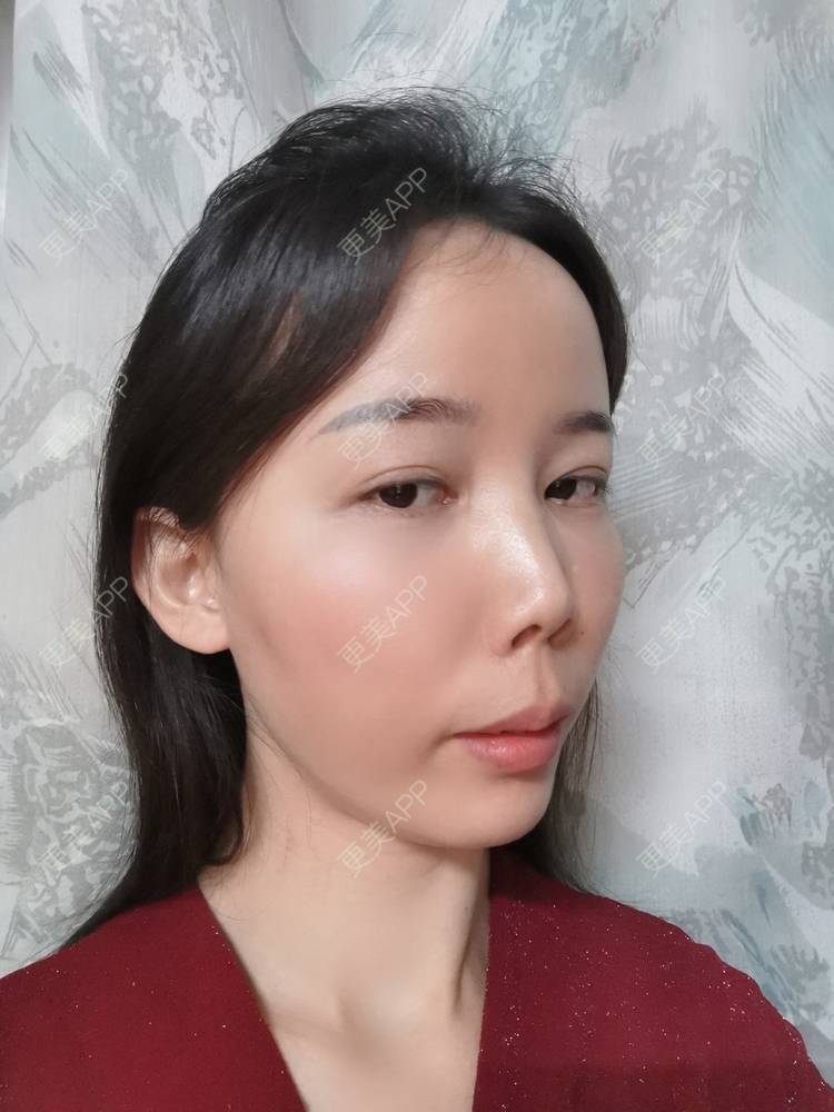 更美 - 更美用户tSMW9UjrQn的水光项目经验 | 广州 | 水光项目