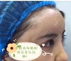 更美 - 更美用户RvtaZv7v51的自体脂肪面部年轻化经验 | 自体脂肪面部年轻化