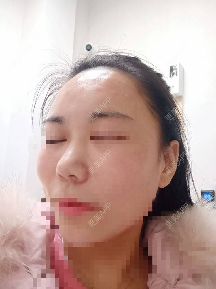 更美 - 更美用户AYz11RTorx的彩光嫩肤经验 | 上海 | 彩光嫩肤