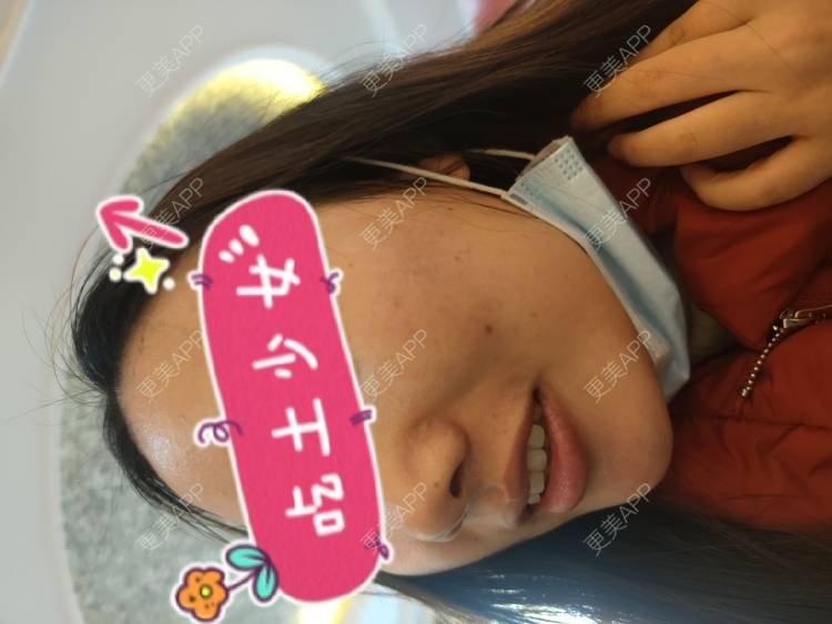 更美 - 淡～的光子嫩肤经验 | 光子嫩肤 | 台州