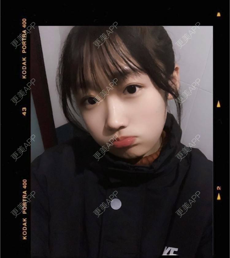 更美 - 更美用户MJvG4pfI08的玻尿酸卧蚕经验 | 玻尿酸卧蚕 | 深圳