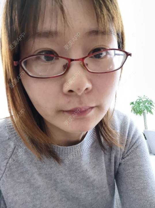 更美 - 更美用户srpv6JiXYY的玻尿酸苹果肌经验 | 玻尿酸苹果肌 | 上海