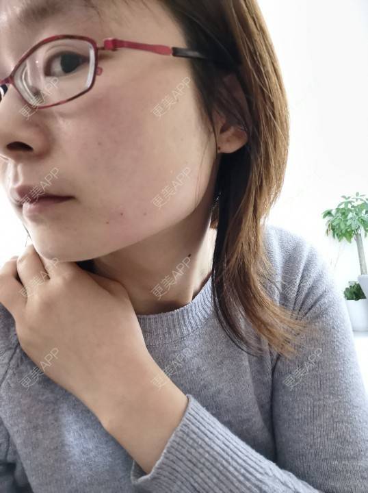 更美 - 更美用户srpv6JiXYY的玻尿酸苹果肌经验 | 玻尿酸苹果肌 | 上海