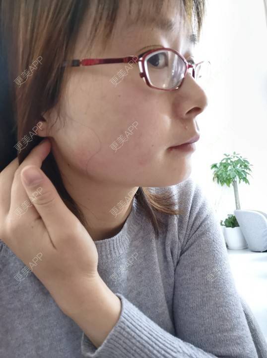 更美 - 更美用户srpv6JiXYY的玻尿酸苹果肌经验 | 玻尿酸苹果肌 | 上海