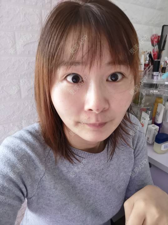 更美 - 更美用户srpv6JiXYY的玻尿酸苹果肌经验 | 玻尿酸苹果肌 | 上海