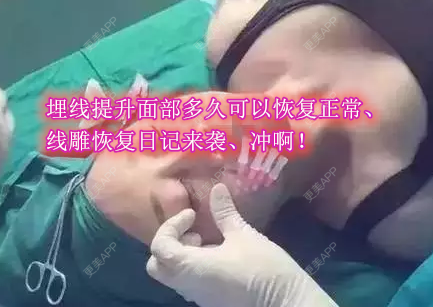 更美 - 像风欧的埋线提升经验 | 北京 | 埋线提升