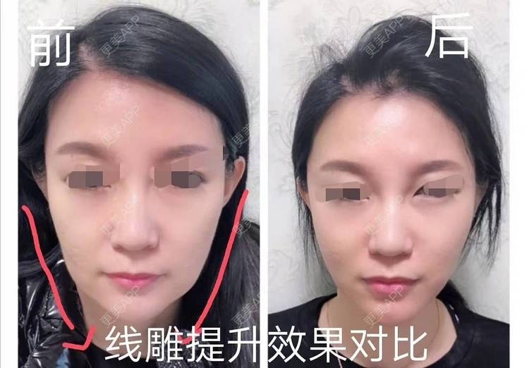 更美 - 像风欧的埋线提升经验 | 北京 | 埋线提升