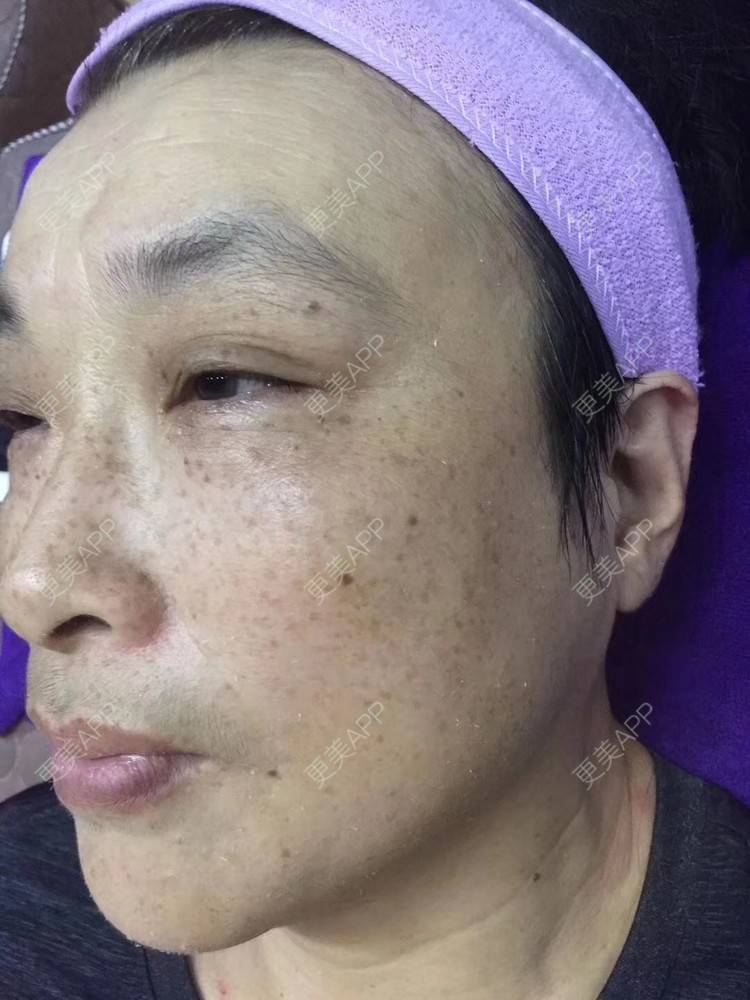更美 - 小可爱 嘤嘤～的光子嫩肤经验 | 激光淡斑 | 淡斑套餐 | 光子嫩肤 | 沈阳