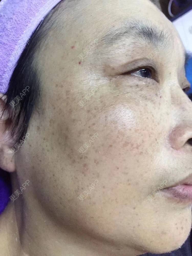 更美 - 小可爱 嘤嘤～的光子嫩肤经验 | 激光淡斑 | 淡斑套餐 | 光子嫩肤 | 沈阳