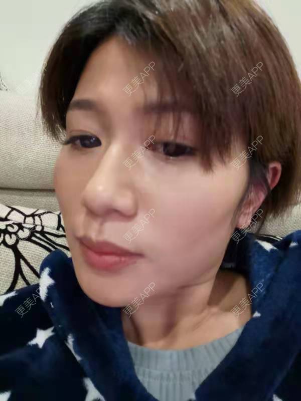 更美 - 更美用户ZyE7pvZfsN的颈部经验 | 热玛吉 | 超声提升 | 除皱 | 颈部 | 除皱套餐