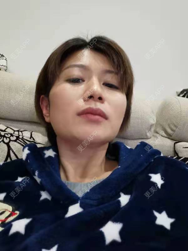 更美 - 更美用户ZyE7pvZfsN的颈部经验 | 热玛吉 | 超声提升 | 除皱 | 颈部 | 除皱套餐