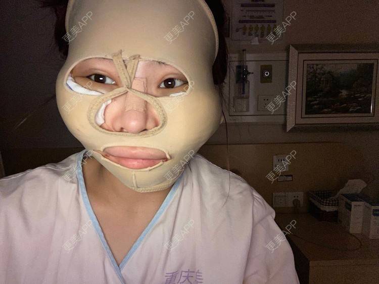 更美 - 以情之名，赌你一生颊的颧骨内推经验 | 颧骨内推 | 重庆