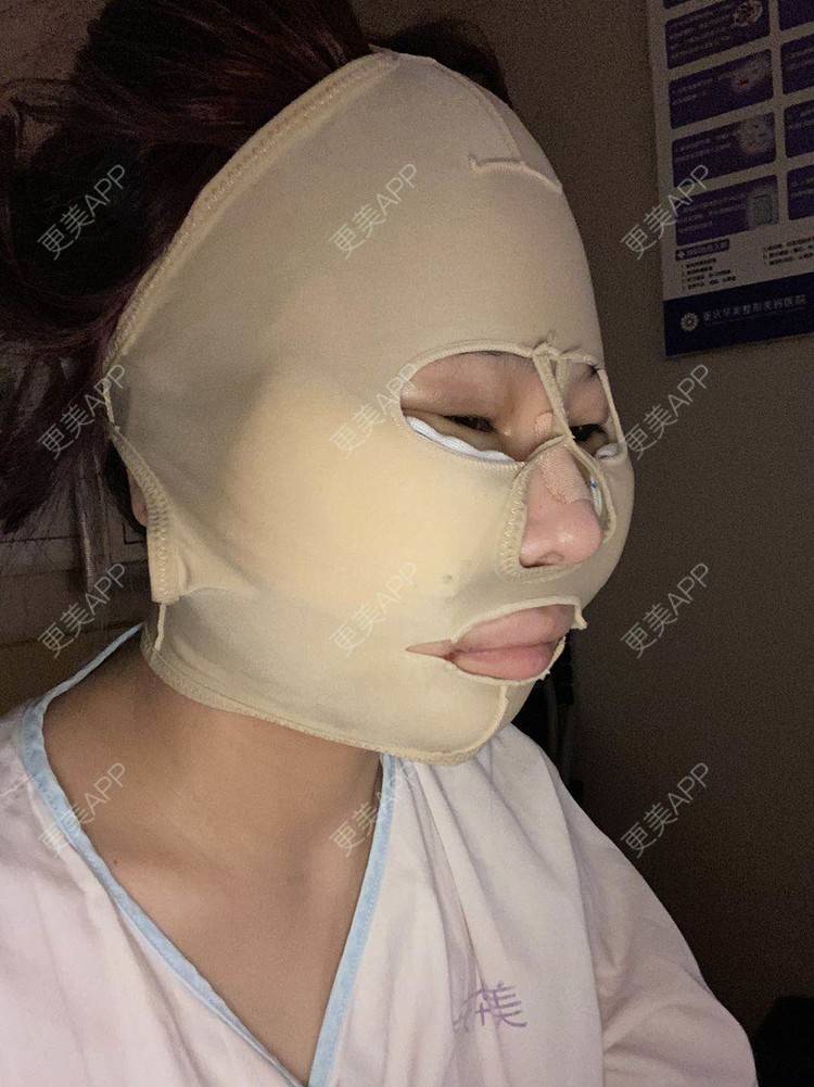 更美 - 以情之名，赌你一生颊的颧骨内推经验 | 颧骨内推 | 重庆