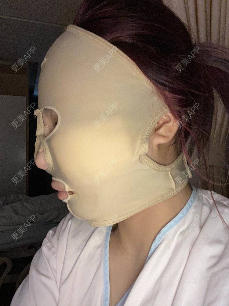 更美 - 以情之名，赌你一生颊的颧骨内推经验 | 颧骨内推 | 重庆