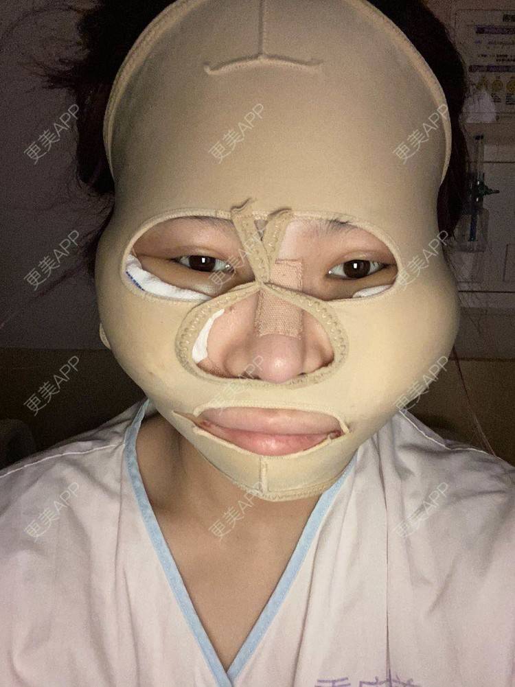 更美 - 以情之名，赌你一生颊的颧骨内推经验 | 颧骨内推 | 重庆